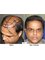 Doctor Saleem Plastic Surgeon - Hair Transplant 