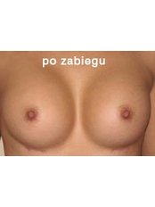 Breast Implants - Euroklinika