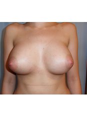 Breast Lift - Euroklinika