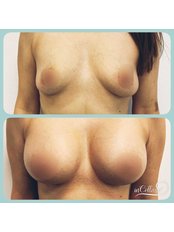 Breast Implants - Allmedica