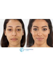 Lower Eyelid Surgery - Both Eyes - Dr Osadowska Clinic