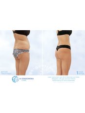 Body-Jet™ Liposuction - Dr Osadowska Clinic Szczecin