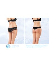 Liposuction - Dr Osadowska Clinic Szczecin