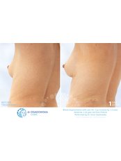 Fat Transfer to Face, Breast or Buttocks - Dr Osadowska Clinic Szczecin