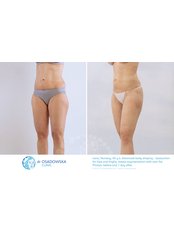 Thigh Liposuction - Dr Osadowska Clinic Szczecin