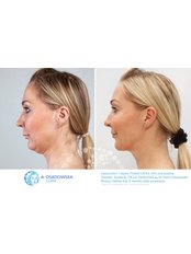 Neck Liposuction - Dr Osadowska Clinic Szczecin