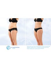 Liposuction - Dr Osadowska Clinic Szczecin