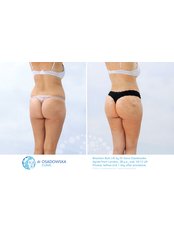 Brazilian Butt Lift - Dr Osadowska Clinic Warsaw