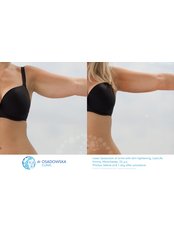 Arm Liposuction - Dr Osadowska Clinic Warsaw