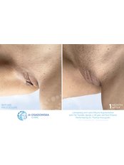 Labiaplasty - Dr Osadowska Clinic Warsaw