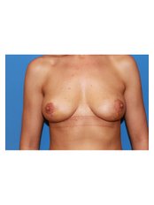 Breast Lift - UNI KLINIK Plastic Surgery