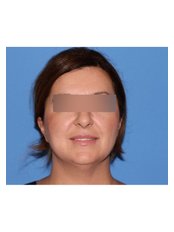 Facelift - UNI KLINIK Plastic Surgery