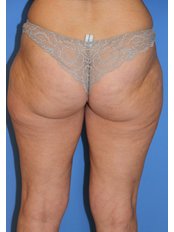 Liposuction - UNI KLINIK Plastic Surgery