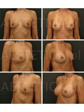 Breast augmentation Mentor CPG332 305cc - AESTETICA Plastic Surgery