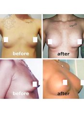 Breast Implants - Beauty Poland Wroclaw
