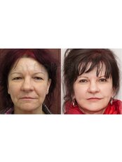 Facelift - Beauty Poland Wroclaw
