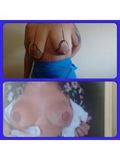 Breast Lift - ClinicForYou