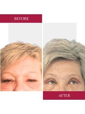 Eyelid surgery - upper lid - CORAMED Beauty Surgery