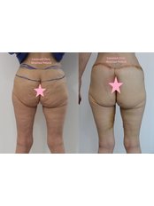 Butt Lift - CORAMED Beauty Surgery