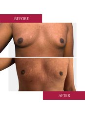 Gynecomastia - male breast reduction - CORAMED Beauty Surgery