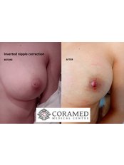 Inverted Nipple Surgery - CORAMED Beauty Surgery