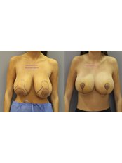 Breast Lift - CORAMED Beauty Surgery