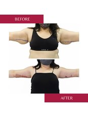 Arm Lift - CORAMED Beauty Surgery