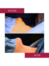 Neck Liposuction - CORAMED Beauty Surgery