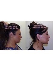 Facelift with necklift - CORAMED Beauty Surgery