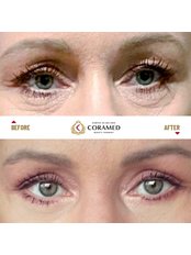 Eyelid surgery - lower lid - CORAMED Beauty Surgery