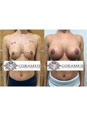 Breast Implants - CORAMED Beauty Surgery