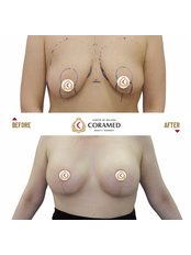 Breast Lift - CORAMED Beauty Surgery