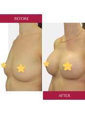 Breast Implants - CORAMED Beauty Surgery