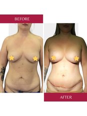 Tummy Tuck with liposuction - CORAMED Beauty Surgery
