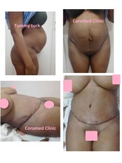 Tummy Tuck - CORAMED Beauty Surgery