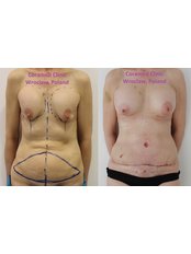 Breast Implant Revision - CORAMED Beauty Surgery
