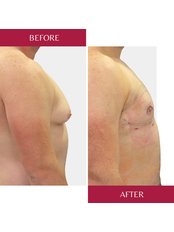 Gynecomastia - male breast reduction - CORAMED Beauty Surgery