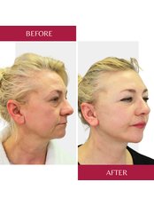 Facelift with necklift - CORAMED Beauty Surgery