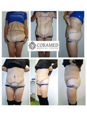 Post Bariatric Plastic Surgery - CORAMED Beauty Surgery