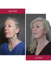 Facelift - CORAMED Beauty Surgery