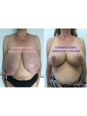 Breast Reduction - CORAMED Beauty Surgery