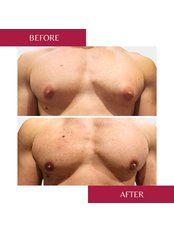 Gynecomastia - CORAMED Beauty Surgery