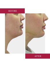 Neck Liposuction - CORAMED Beauty Surgery