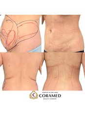 Liposuction - CORAMED Beauty Surgery