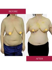 Breast Reduction - CORAMED Beauty Surgery