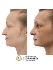 Rhinoplasty - CORAMED Beauty Surgery