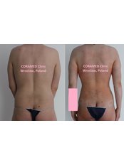 Body-Jet™ Liposuction - CORAMED Beauty Surgery