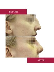 Rhinoplasty - CORAMED Beauty Surgery