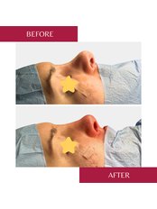 Nasal Tip Surgery - CORAMED Beauty Surgery