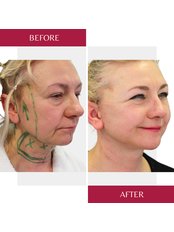 Neck Lift - CORAMED Beauty Surgery